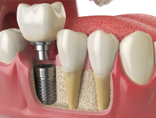LID-dental-implant